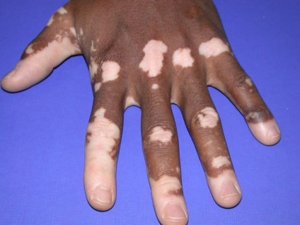 Mik a tünetei és okai vitiligo