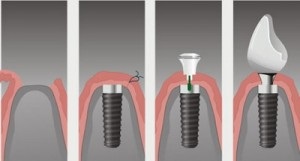 Cum se elimină umflarea obrazului după implantarea dinților