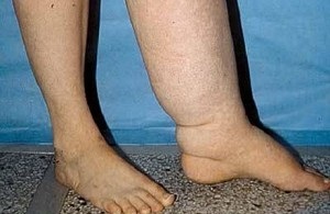 Cum de a alege ciorapi de compresie pentru vene varicoase recenzii, ciorapi pentru femei gravide, o revizuire