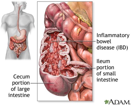 Cum se vindeca colita la domiciliu - colita cronica a intestinului cum se trateaza tratamentul in