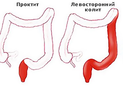 Cum se vindeca colita la domiciliu - colita cronica a intestinului cum se trateaza tratamentul in