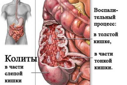 Cum se vindeca colita la domiciliu - colita cronica a intestinului cum se trateaza tratamentul in