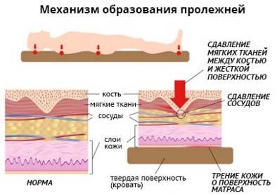 Класификация на видовете декубитални рани, етап и степен