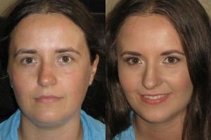 American Beauty Clinic bőrgyógyászat, arc kontúrjait korrekció