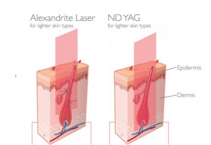 Cromoforii țintă pentru terapia laser și lungimea de undă a laserului