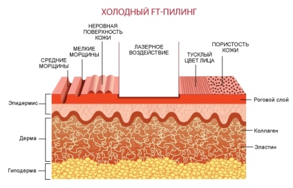 Peeling cu laser pe piele