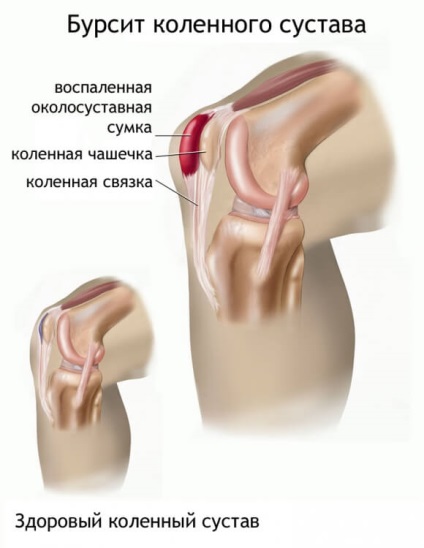 Tratamentul artritei, bursitei, osteoartritei și a altor boli articulare