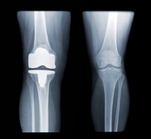 Tratamentul artritei, bursitei, osteoartritei și a altor boli articulare