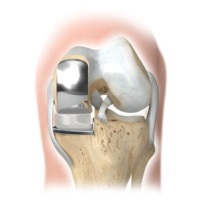 Tratamentul artritei, bursitei, osteoartritei și a altor boli articulare