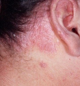 Tratamentul și prevenirea remediilor eczeme populare - cauze, tipuri de boli, ca