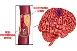 Tratamentul medicamentelor vasculare cerebrale ischemice