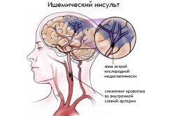 Tratamentul medicamentelor vasculare cerebrale ischemice