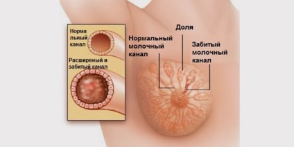 Tratamentul lactostaziei la domiciliu cu antibiotice împotriva temperaturii, unguentelor, compreselor