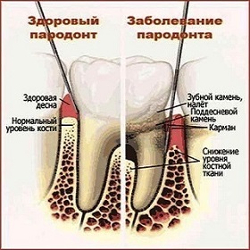 Tratamentul bolilor parodontale remedii populare, ajusta la succes