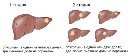 Tratamentul cancerului hepatic în cadrul departamentului de oncologie pspbgmu, costul tratamentului tumorilor la St. Petersburg