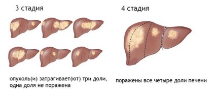 Tratamentul cancerului hepatic în cadrul departamentului de oncologie pspbgmu, costul tratamentului tumorilor din Sankt Petersburg
