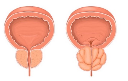 Un remediu pentru tratamentul adenomului de prostată la bărbați