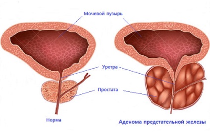 Un remediu pentru tratamentul adenomului de prostată la bărbați