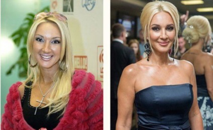 Lera Kudryavtseva înainte și după operațiunea pe plastic (foto)
