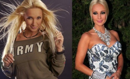 Lera Kudryavtseva înainte și după operațiunea pe plastic (foto)