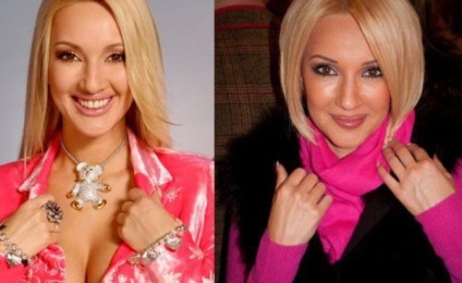 Lera Kudryavtseva înainte și după operațiunea pe plastic (foto)