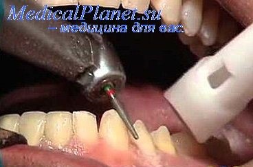 Turnarea metalelor prețioase în stomatologie