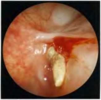 Metoda de endoscopie a sinusului maxilar