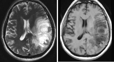 Mrt expert, мрт în diagnosticarea unor forme rare de scleroză multiplă