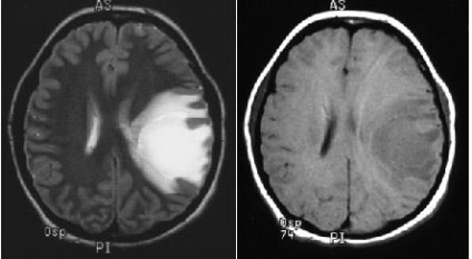 Mrt expert, мрт în diagnosticarea unor forme rare de scleroză multiplă