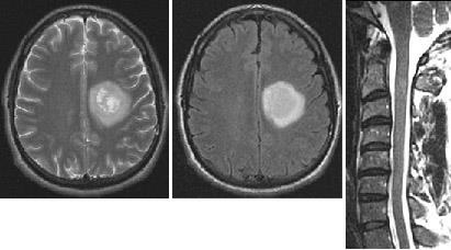 Mrt expert, мрт în diagnosticarea unor forme rare de scleroză multiplă