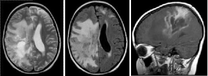 Mrt expert, мрт în diagnosticarea unor forme rare de scleroză multiplă