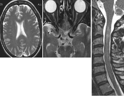 Mrt expert, мрт în diagnosticarea unor forme rare de scleroză multiplă