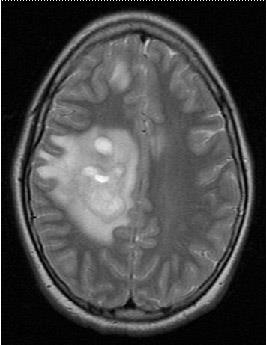 MRI szakértő MRI a diagnózis ritka formája a sclerosis multiplex