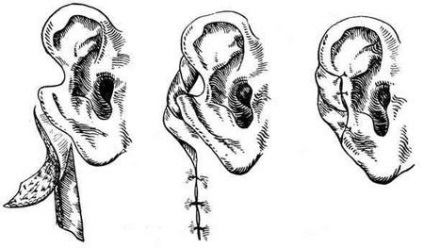 Chirurgie pentru a restabili auriculul