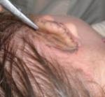 Operație pentru a restabili reconstrucția urechii rupte a urechii cu microtia sau traumă