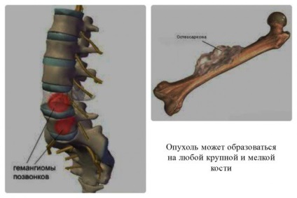 Tumorile osului pentru tratamentul video - chirurgical