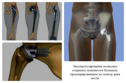 Tumorile osului pentru tratamentul video - chirurgical