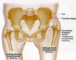 Fractură a femurului, fractură transversală a femurului, fractură de os osos la vârstnici