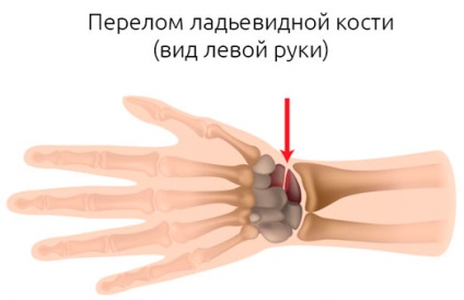Fractura de tratament pentru încheietura mâinii scapoide, simptome și recuperare