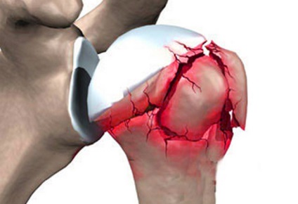 Fractura simptomelor articulațiilor umărului, prim ajutor, tratament și reabilitare
