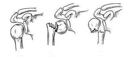Fractura simptomelor articulațiilor umărului, prim ajutor, tratament și reabilitare
