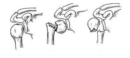 Перелом плечового суглоба симптоми, перша допомога, лікування та реабілітація