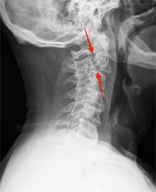 Fractura coloanei vertebrale cervicale, simptome, diagnostic și tratament