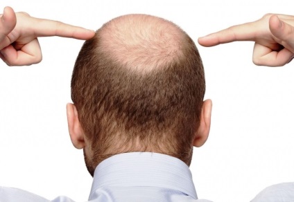 Transplantul de păr la bărbați este cea mai eficientă metodă de restaurare a părului