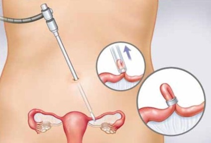 Ligarea trompelor uterine - argumentele pro și contra, consecințele