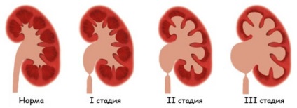 Pyelectasia vese csecsemők, újszülöttek okai, kezelése