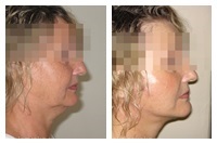 Facelift, lifting facial și de gât, 