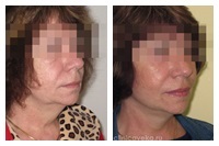 Facelift, lifting facial și de gât, 