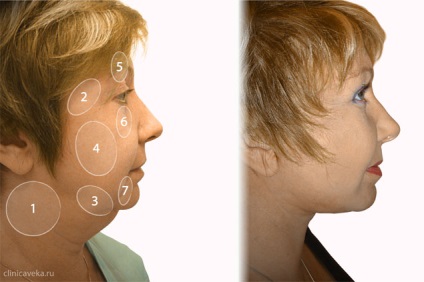 Facelift, lifting facial și de gât, 