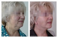 Facelift, lifting facial și de gât, 